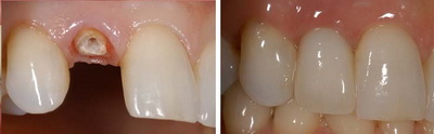 Протезирование передних зубов 